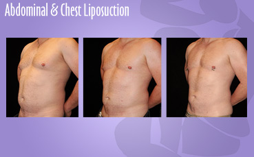 Abdominal + Chest Liposuction