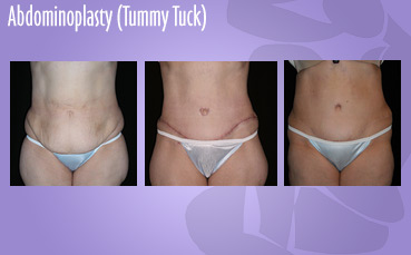 Abdominoplasty, Tummy Tuck