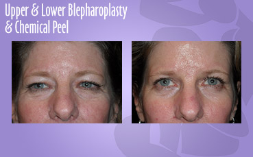 Upper and lower lid blepharoplasty and chemical peel