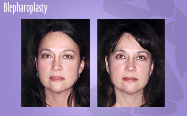 Upper and lower lid blepharoplasty and chemical peel