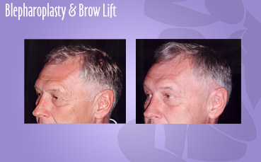 Blepharoplasty and Brow Lift