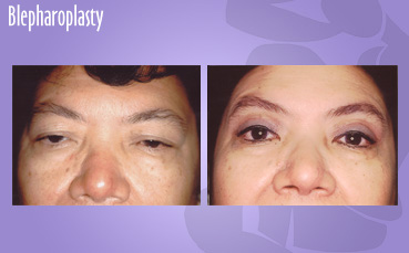 Seattle Cosmetic eyelid surgery