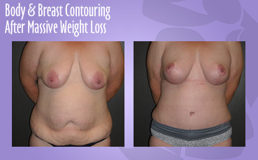 Body + Breast Contour Massive Weight Loss