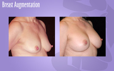 Seattle Breast Implant Surgeon