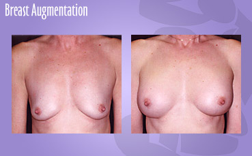 Breast implant surgery by Seattle Plastic Surgeon