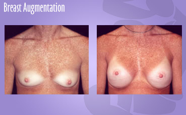 Breast Augmentation by Seattle Plastic Surgeon, Dr. Lisa Lynn Sowder