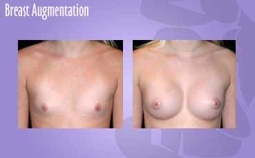 Breast Augmentation by Seattle Plastic Surgeon, Dr. Lisa Lynn Sowder