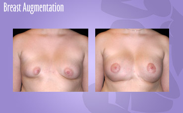 Tuberous Breast asymmetry treatment in Seattle by Seattle Plastic Surgeon