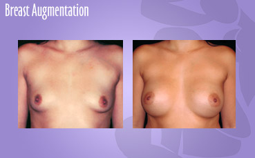 Breast Augmentationn by Seattle Plastic Surgeon, Dr. Lisa Lynn Sowder