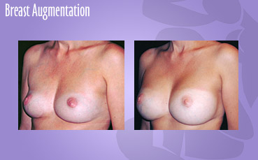 Seattle Breast Augmentation Surgeon