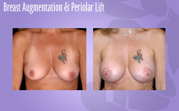 Breast Augmentation and Periolar Lift by Seattle Plastic Surgeon, Dr. Lisa Lynn Sowder