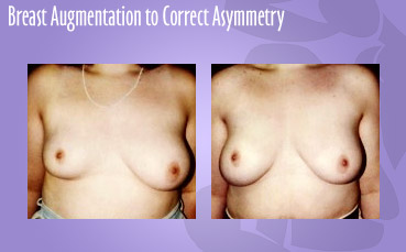 Breast Asymmetry Treatment by Seattle Plastic Surgeon, Dr. Lisa Lynn Sowder