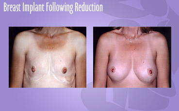 Breast Implant Following Reduction by Seattle Plastic Surgeon, Dr. Lisa Lynn Sowder