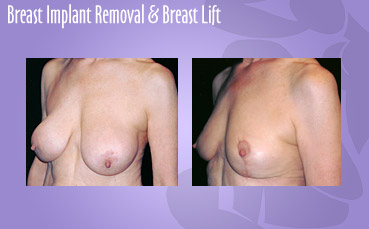 Breast Implant Removal and Breast Lift