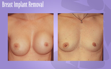 Breast Implant Removal by Seattle Plastic Surgeon, Dr. Lisa Lynn Sowder