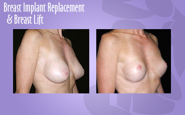 Breast-Implant-Replace-Breast-Lift