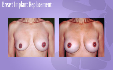 Breast-Implant-Replacement