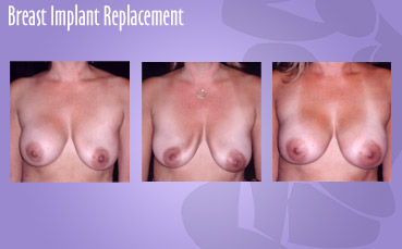 Breast Implant Replacement by Seattle Plastic Surgeon, Dr. Lisa Lynn Sowder