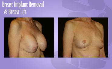 Breast Implant Removal Breast Lift