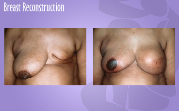 Breast Reconstruction by Seattle Plastic Surgeon, Dr. Lisa Lynn Sowder