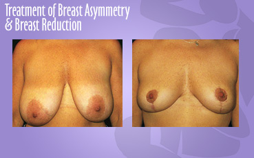 Breast Asymmetry + Reduction