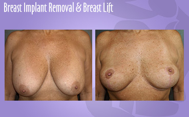 Breast Implant Removal & Lift