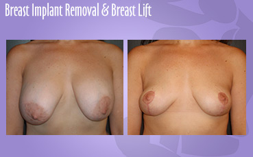 Breast Implant Removal & Breast Lift