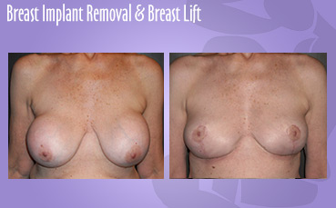 Breast Implant Removal & Lift