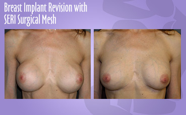 Breast Implant Revision with Seri Surgical Mesh