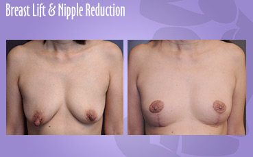 This 30 something mother of three had very full breasts prior to childbearing and breast feeding. She wanted restoration of her size and shape. I did and augmentation with 500 cc gel implants and also did a periareolar lift. She feels like she is back to her pre-pregnancy self.