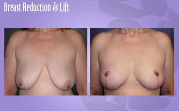Breast Reduction and Lift