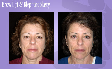 Brow Lift and Blepharoplasty by Seattle Plastic Surgeon