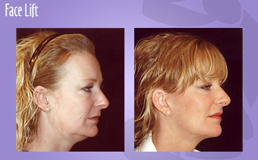 Face Lift by Seattle Plastic Surgeon, Dr. Lisa Lynn Sowder