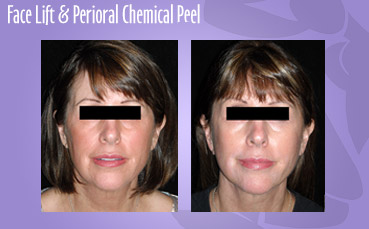 Facelift and perioral chemical peel