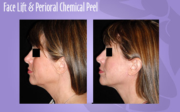 Facelift and perioral chemical peel