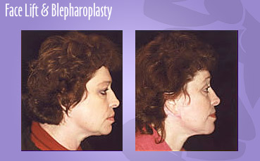 Facelift with Blepharoplasty by Seattle Plastic Surgeon, Dr. Lisa Lynn Sowder
