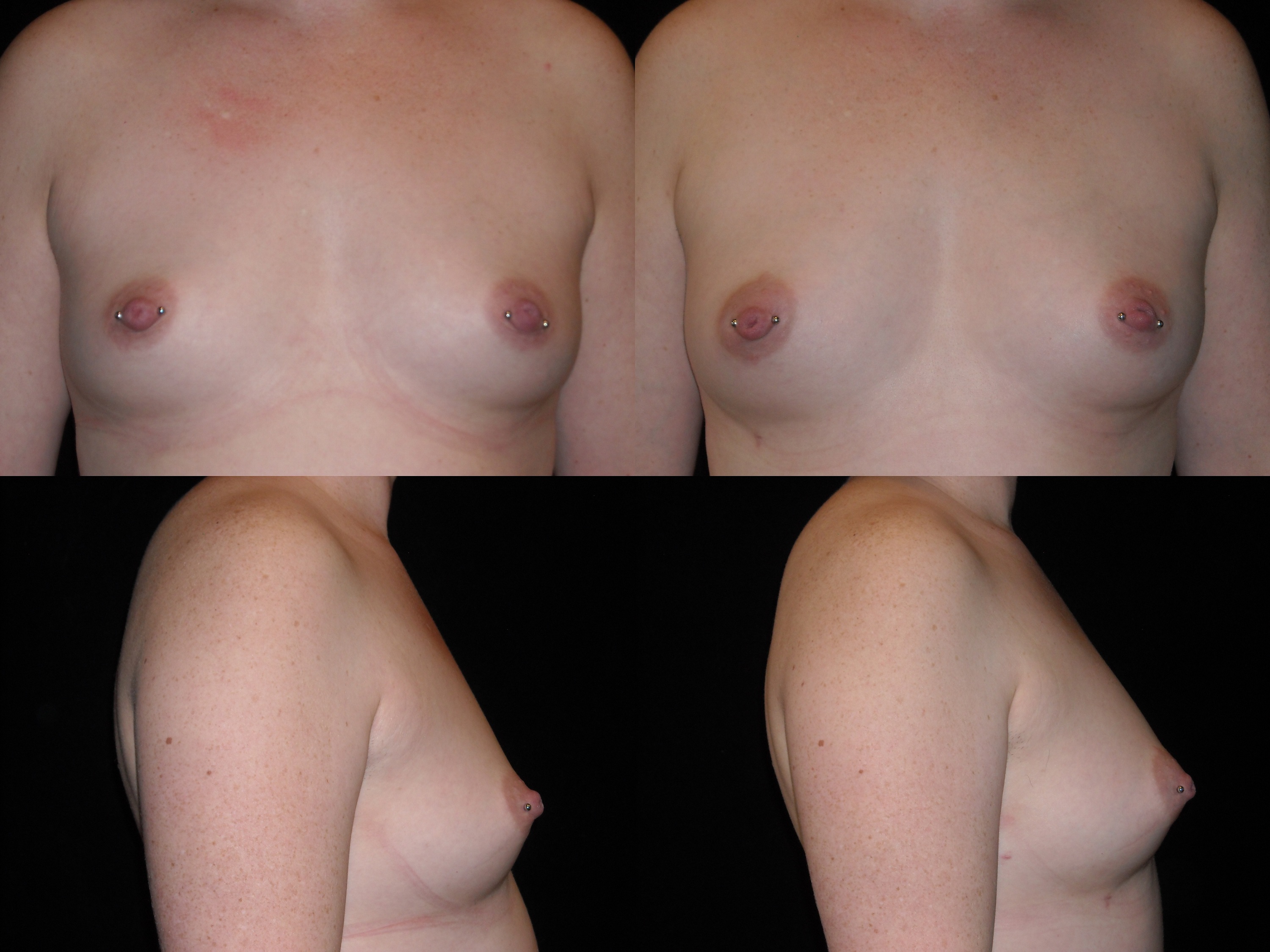fat breast augmentation