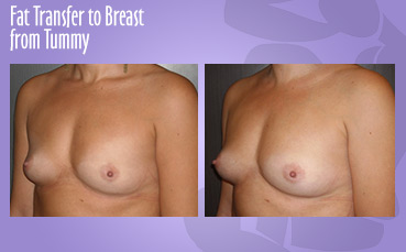 Fat Transfer to Breast from Tummy
