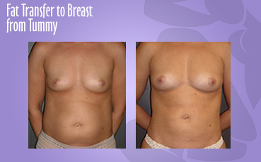Fat Transfer to Breast from Tummy