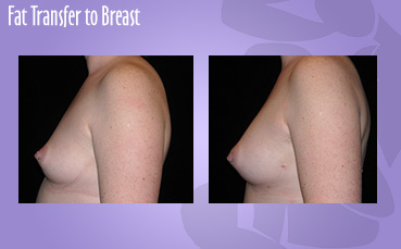 Fat Transfer to Breasts