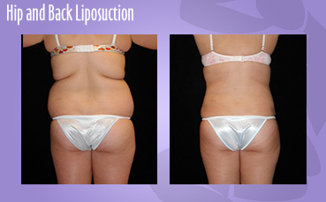 Hip + Back Liposuction