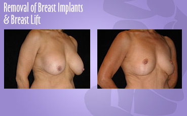 Implant Removal & Lift