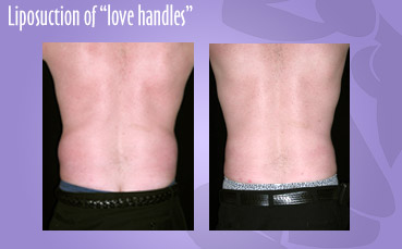 Liposuction of male love handles by Seattle Plastic Surgeon