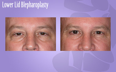 Lower lid blepharoplasty