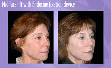 Mid face lift with Endotine fixation device by Seattle Plastic Surgeon