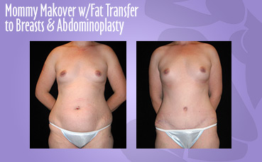 Mommy Makeover Fat Transfer + Abdominoplasty