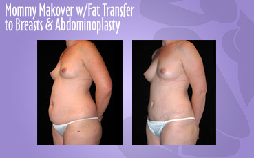 Mommy Makeover Fat Transfer