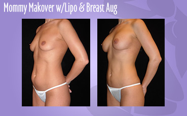 Mommy Makeover Lipo Breast Aug
