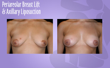 Periareolar breast lift and axillary liposuction