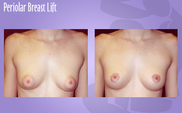 Periolar Breast Lift